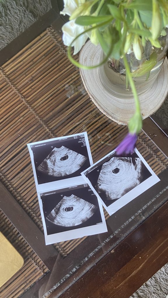 fotos de um ultrassom mostrando uma gravidez anembrionária